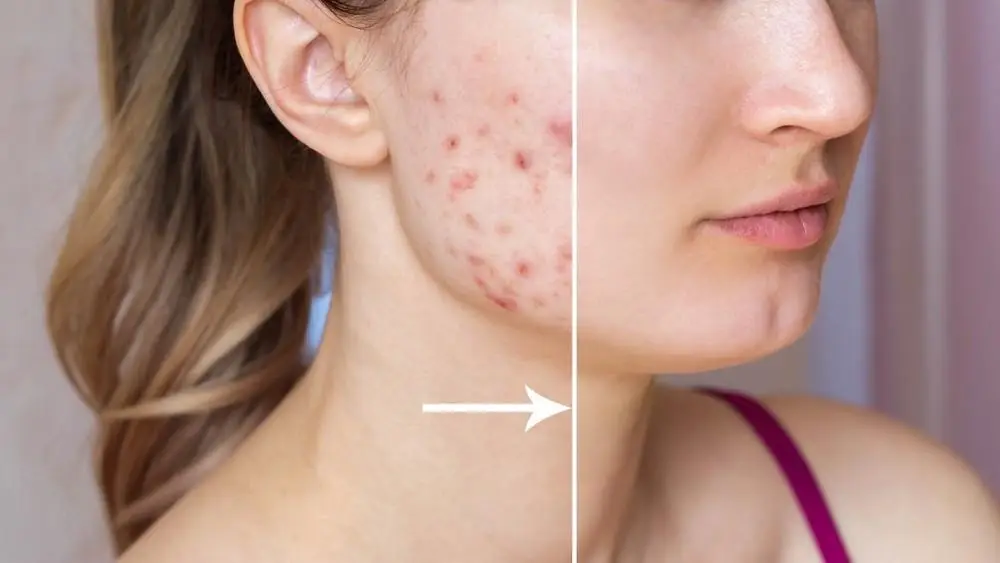 You Don’t Have to Live With Adult Acne – Modern Aesthetica, Beverly Hills