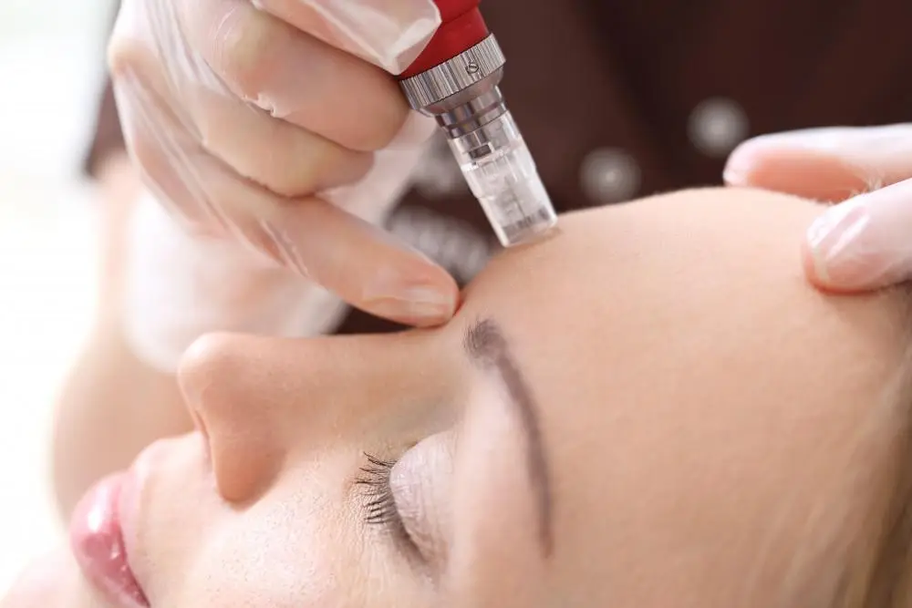 4 Benefits of Microneedling – Modern Aesthetica, Beverly Hills