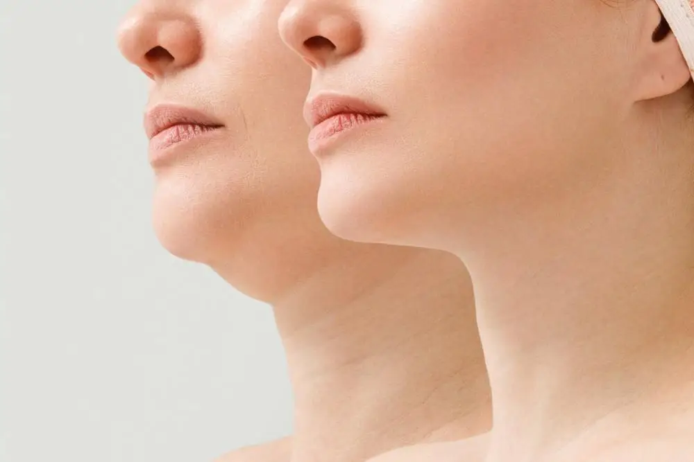 How Kybella® Melts Away Your Double Chin – Modern Aesthetica, Beverly Hills