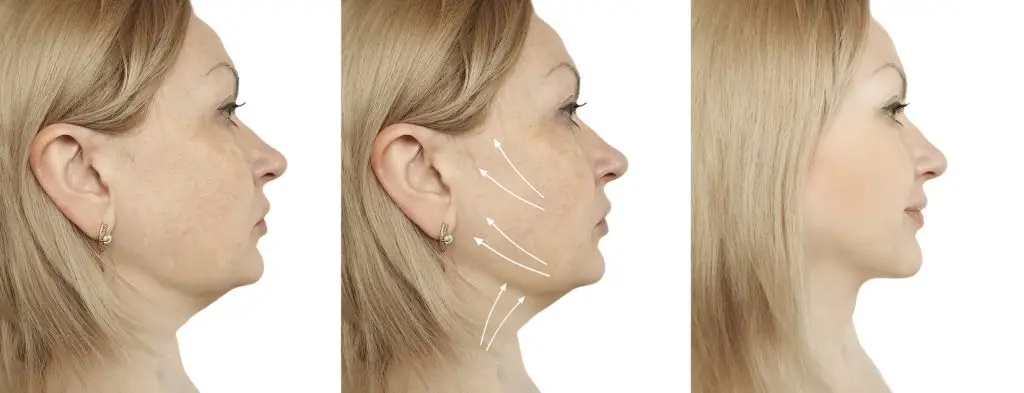 Lift and sculpt your jawline without surgery. Explore advanced non-surgical lower face lift treatments at Modern Aesthetica in Beverly Hills.